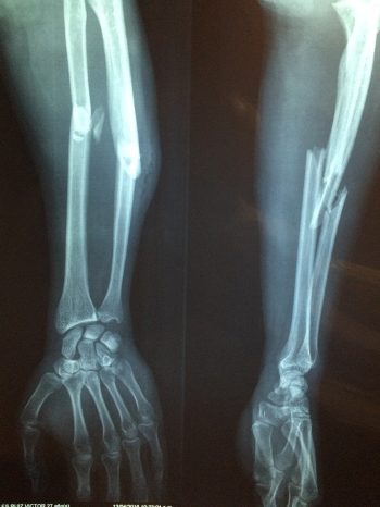 fracture-bone-xray-skeleton-2333164